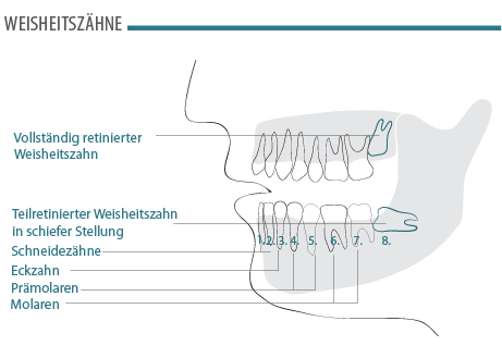 weisheitszaehne.png 